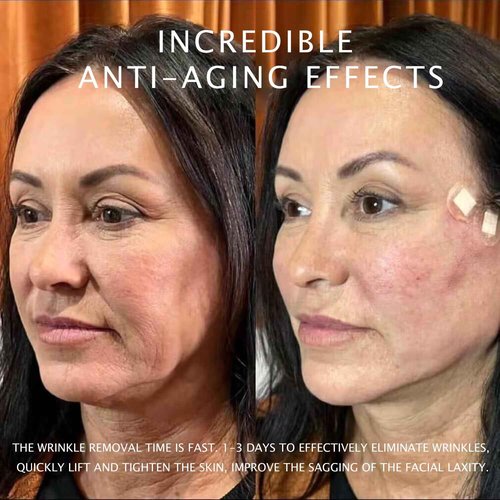 PHYMAT ACADA Pdo Threads for Face Lift Cog 18G100mm Pdo Fishbone Thread Bullet Blunt Cog Threads for Face Lift 20Pcs