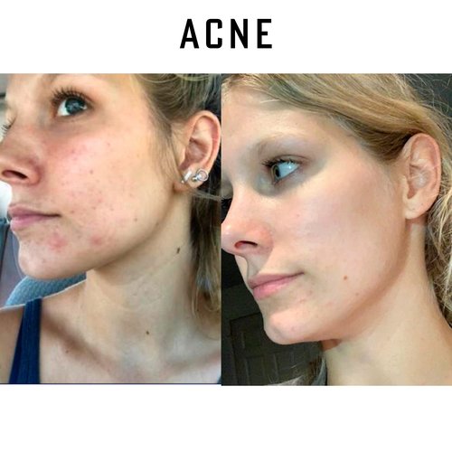 Simply O3 Pure Organic Ozonated Olive Oil Orginal Strength 800 Peroxide For Face and Skin Helps In Acne, Anti-Aging, Wrinkles and Rosacea For Sensitive Skin with Made in Spain