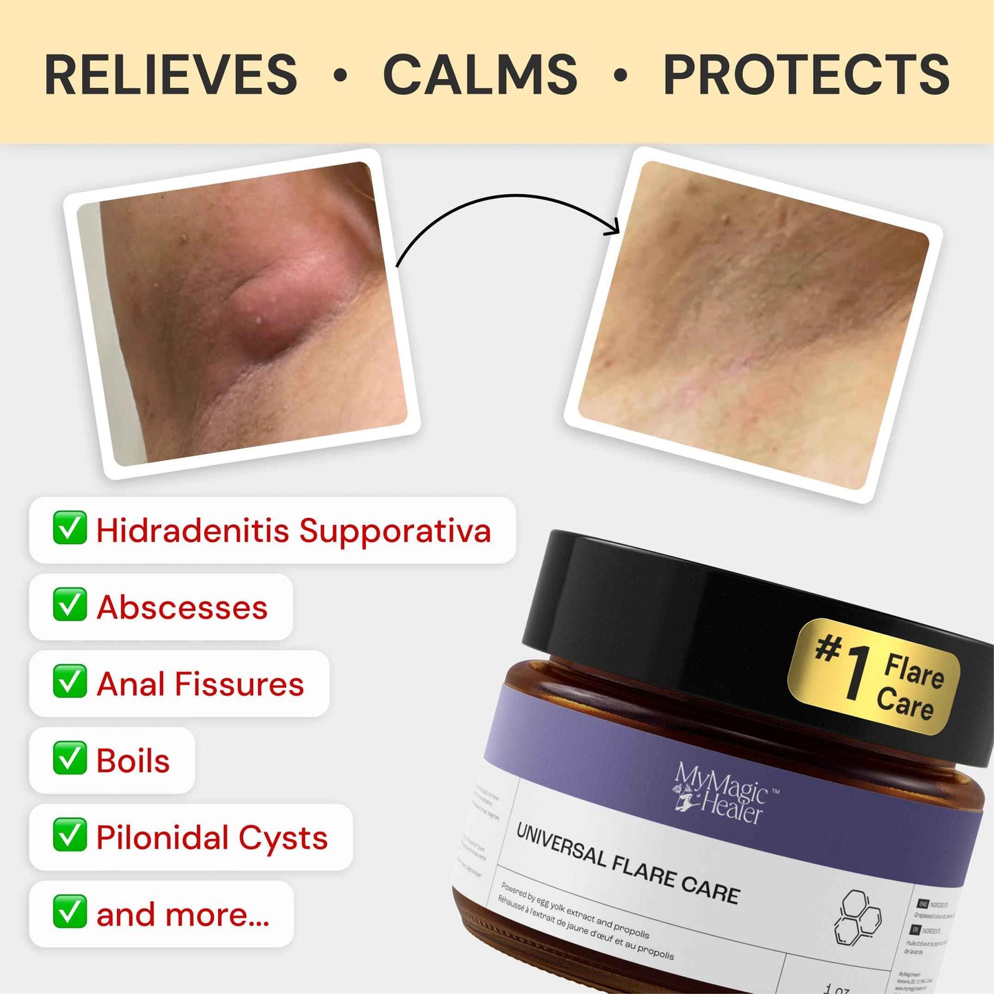 MyMagicHealer Comfort Flare Care | 1oz Collection of All-Natural Salves for Skin Flare-Ups Convenient Relief for Skin Flare-Ups, Acne, Boils, Muscle & Joint Discomfort – Perfect for Travel