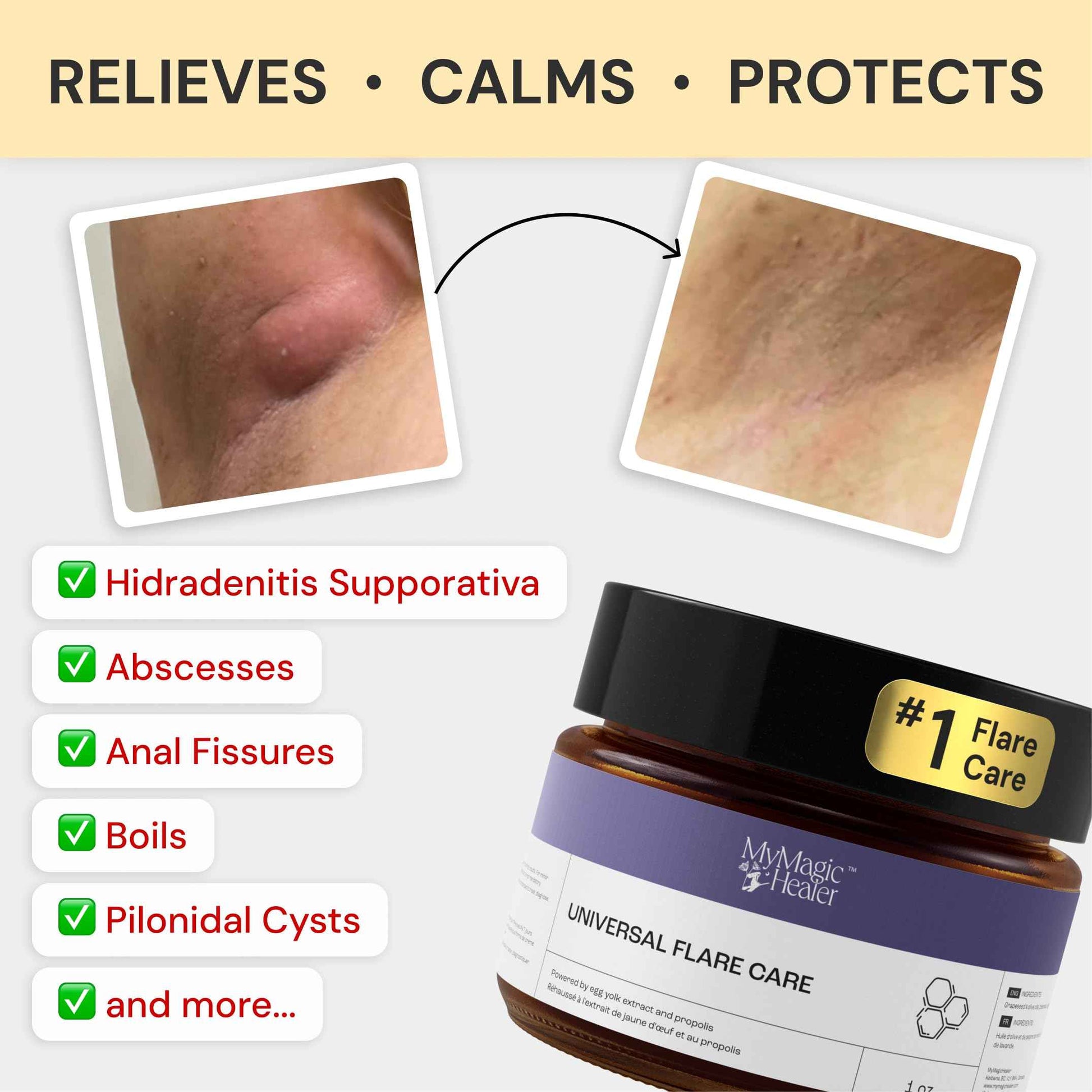 MyMagicHealer Comfort Flare Care | 1oz Collection of All-Natural Salves for Skin Flare-Ups Convenient Relief for Skin Flare-Ups, Acne, Boils, Muscle & Joint Discomfort – Perfect for Travel