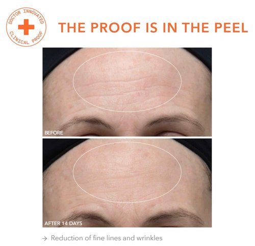 Dr. Dennis Gross Alpha Beta Ultra Gentle Daily Peel: for Dehydrated or Sensitive Skin, Uneven Tone or Texture, Fine Lines or Enlarged Pores (30 Treatments)
