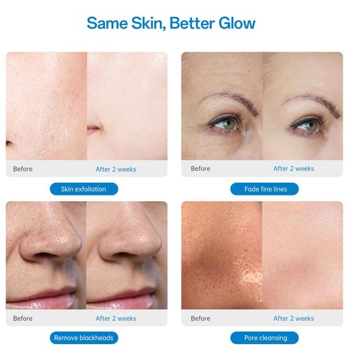 UNOISETION At Home Microdermabrasion Machine, 2 In 1 Pro-Grade Diamond Dermabrasion Facial for Exfoliation & Stubborn Blackheads, Microdermabrasion Tool for Radiant Skin, White