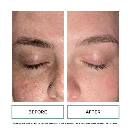 Replenix Pore Minimizing Face Serum with Medical-Grade Niacinamide, Lactic & Salicylic Acids, Dermatologist-Recommended for Large Pores & Uneven Skin (1 fl. oz)