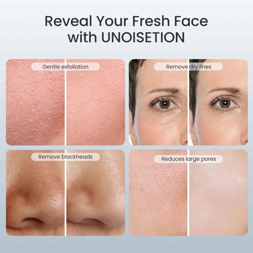 UNOISETION Diamond Microdermabrasion Machine, New Upgraded Home Dermabrasion Facial Machine for Blackhead Removal, Home Use Facial Skin Care Equipment