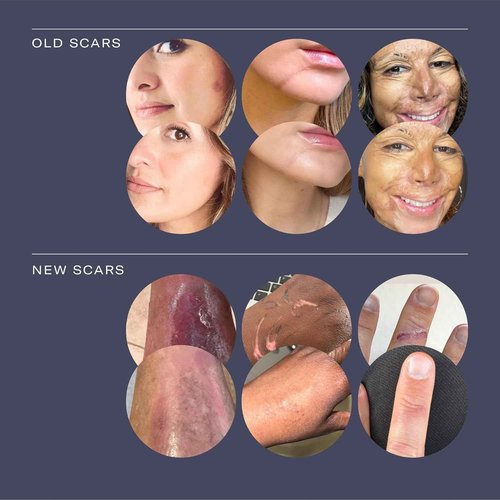 ESTAS Beauty Scar Cream -Daily Vitamin E & C with Silicone, 1 oz -Effective for Old & New Scars on Face & Body, Ideal for Surgical, Burn, C-Section & Acne Scars, Vegan + Cruelty Free, Fragrance Free