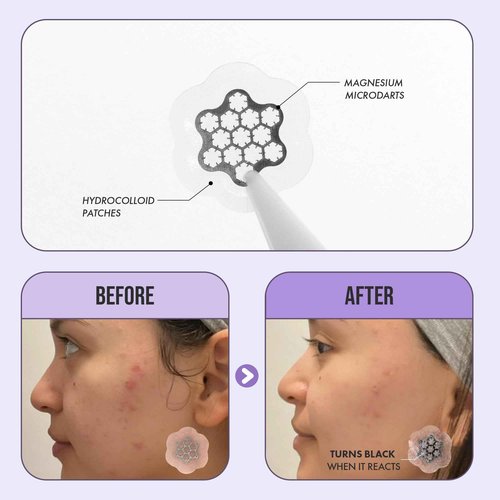 Deep Blemish Microdarts | Pimple Patch | Fast-Acting | Quick Calming | 99.9% Pure Magnesium | Madecassic Acid | Tea Tree | Eucalyptus Leaf | Hydrocolloid Spot Care Patch (ALL SIZE 39 PCS)