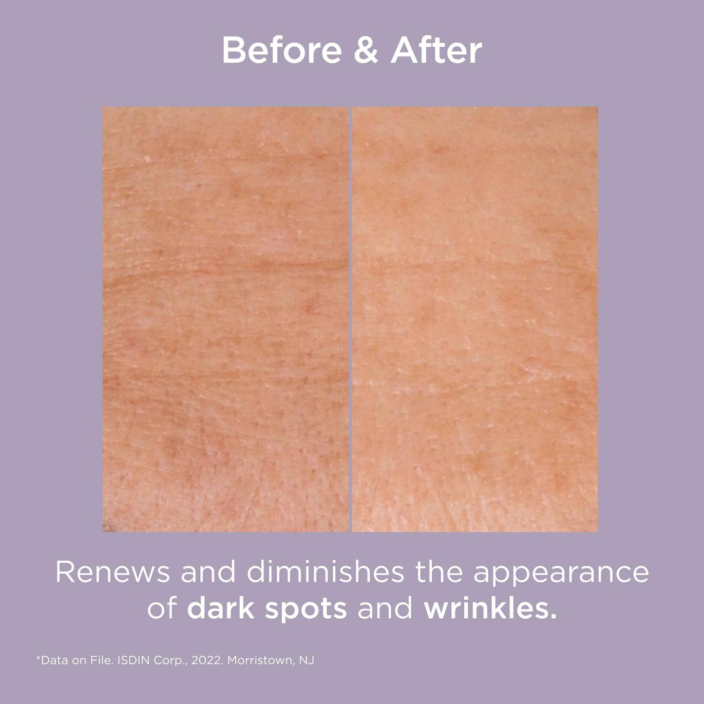 Glicoisdin 25 Intense - Gel Exfoliant for Face with Glycolic Acid - 1.76 OZ