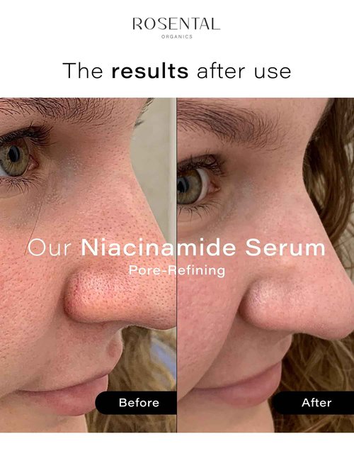 Rosental Organics Niacinamide Serum + Pore-Refining Treatment - 5% niacinamide to lighten pigmentation spots and acne scars