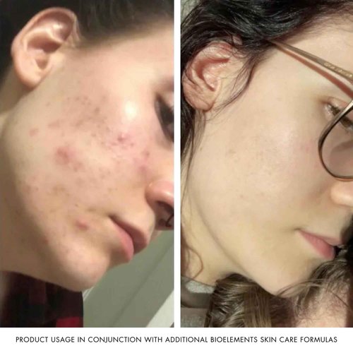 Bioelements Kerafole - 2.5 fl oz - Deep-Purging Facial Mask for Fresh, Radiant Skin - Vegan, Gluten Free - Never Tested on Animals