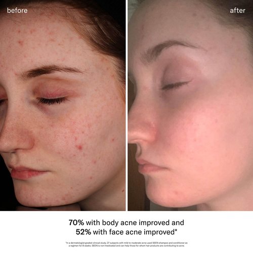 SEEN Acne-Safe Bundle - Fragrance Free- Shampoo, Conditioner & Pimple Patches – Non-Comedogenic, Dermatologist-Developed, Safe for Sensitive, Eczema & Acne-Prone Skin