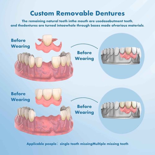Partial Dentures - Custom Removable Personalized Tooth Replacement Set for Missing Teeth & Gap (1 Tooth)