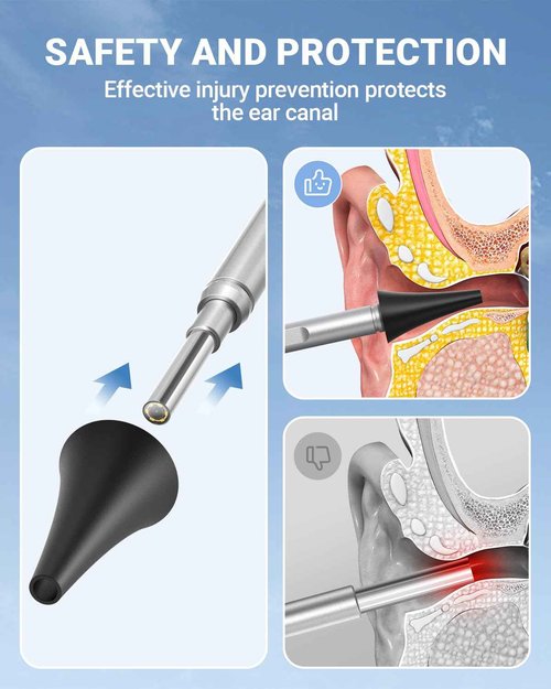 ScopeAround Otoscope Ear Camera with 4.5" IPS Screen, FHD Digital Otoscope with Gyroscope, FSA HSA Eligible Item, 32GB Card Ear Scope Otoscope with Light, Ear Wax Removal Tool Camera, Home Ear Checker