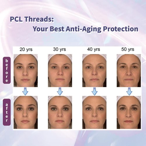 PCL Cog Threads 4D COG PDO Thread for Face Lifting 360R Bidirectional Barb (Blunt-Type) PCL Threads for Face/Whole Body Lift 19G100mm 10pcs