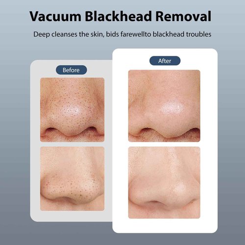 Hydrapore Blackhead Remover Pore Vacuum, 5 in 1 Blackhead Remover Tools with Hot & Cold Compress, Blackhead Extractor with 2 Suckers 3 Suction Power, Face Vacuum Pore Cleanser for Women & Men