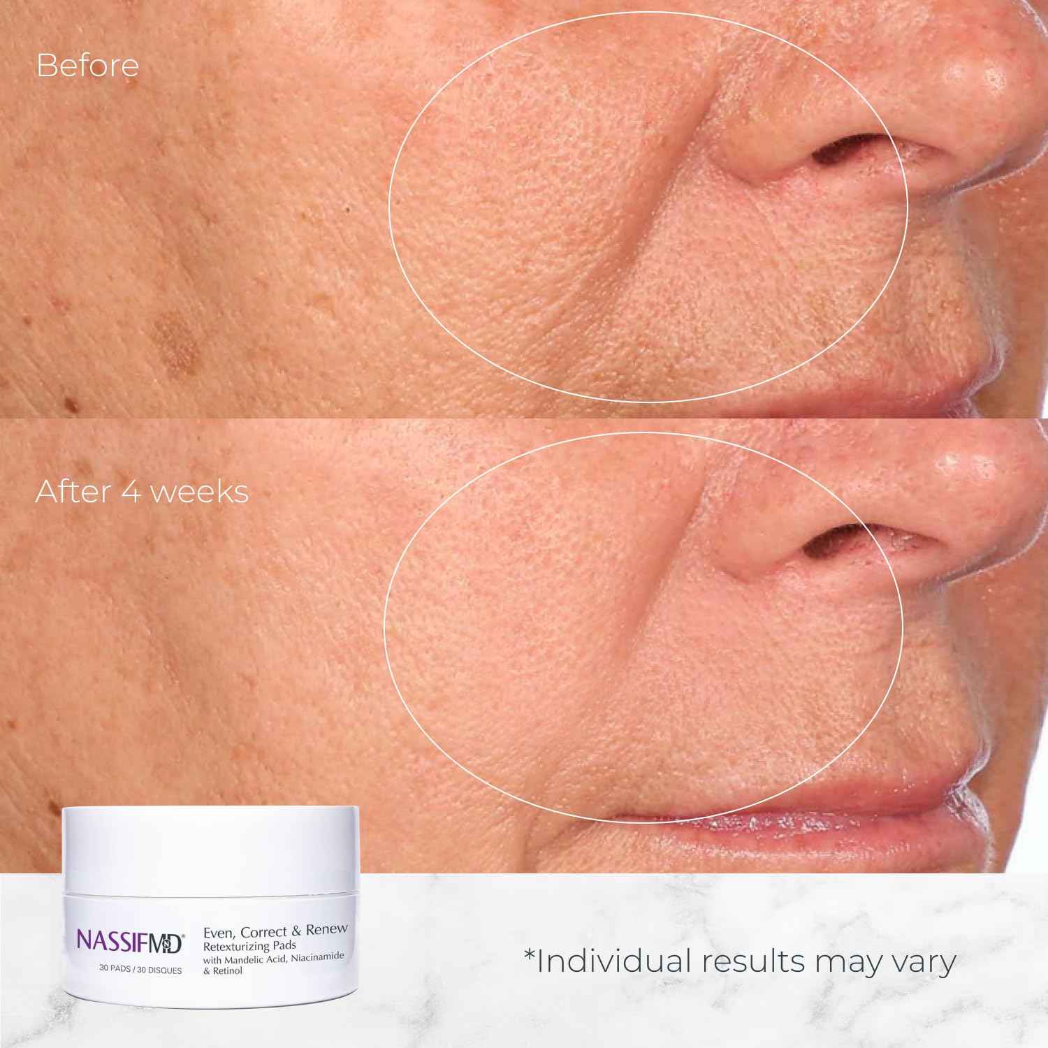 NassifMD Even, Correct & Renew Retexturizing Pads | Chemical Peel for Face | Whitehead, Closed Comedone and Acne Marks Skin Resurfacing Pads | Hyperpigmentation Treatment for Face