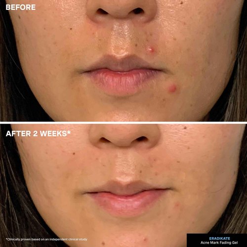 Kate Somerville EradiKate Acne Mark Fading Gel - Salicylic Acid Acne Treatment - Visibly Reduces Acne Scars, Clears Skin & Prevents Breakouts, 1 Fl Oz