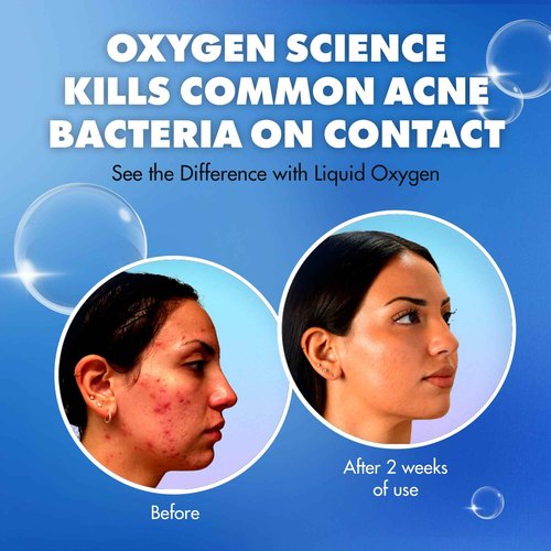 Liquid Oxygen Acne Treatment System for Acne-Prone Skin | Oxygen-Infused | Cleansing Wash, Blackhead Astringent & Hydrating Moisturizer | Blemish Control & Pimple Treatment | Dermatologist-Recommended