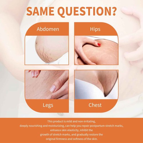 Stretch Mark System, Infused with Collagen and Elastin Support – Hydrating & Nourishing Formula for Smoother Looking Skin (1)