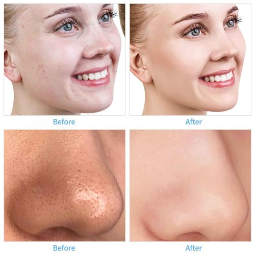 mcwdoit Facial Microdermabrasion, Diamond Dermabrasion Machine for Skin Exfoliation Blackhead Removal,Portable Rechargeable USB Cleansing Cordless White Home Device for Girl Women as a Gift, Upgraded
