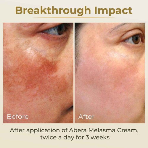 ABERA Melasma Cream (Premium Version) - Dark Spot Corrector, Melasma, Freckle, Sun Spot, Age Spot Remover Advanced Formula for Women and Men (set 2)