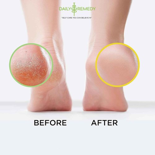 DAILY REMEDY 4-Pack Foot Soak Set - 2 Extra Strength Tea Tree Oil & 2 Citrus Detox - Made In USA - Soothes Tired Feet, Athletes Foot, Stubborn Foot Odor, Softens Calluses & Refreshes & Detoxifies