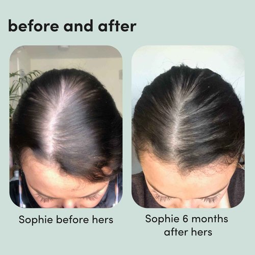 HIMS & HERS hers Triple Threat System Total Hair Package to Supports Hair Growth Minoxidil 2%, Shampoo, Conditioner, Biotin Hair Kit - 4pc