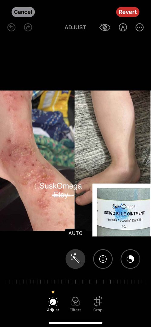 Indigo Blue Ointment 8oz, Psoriasis, Eczema, Diaper Rash, Suskomega