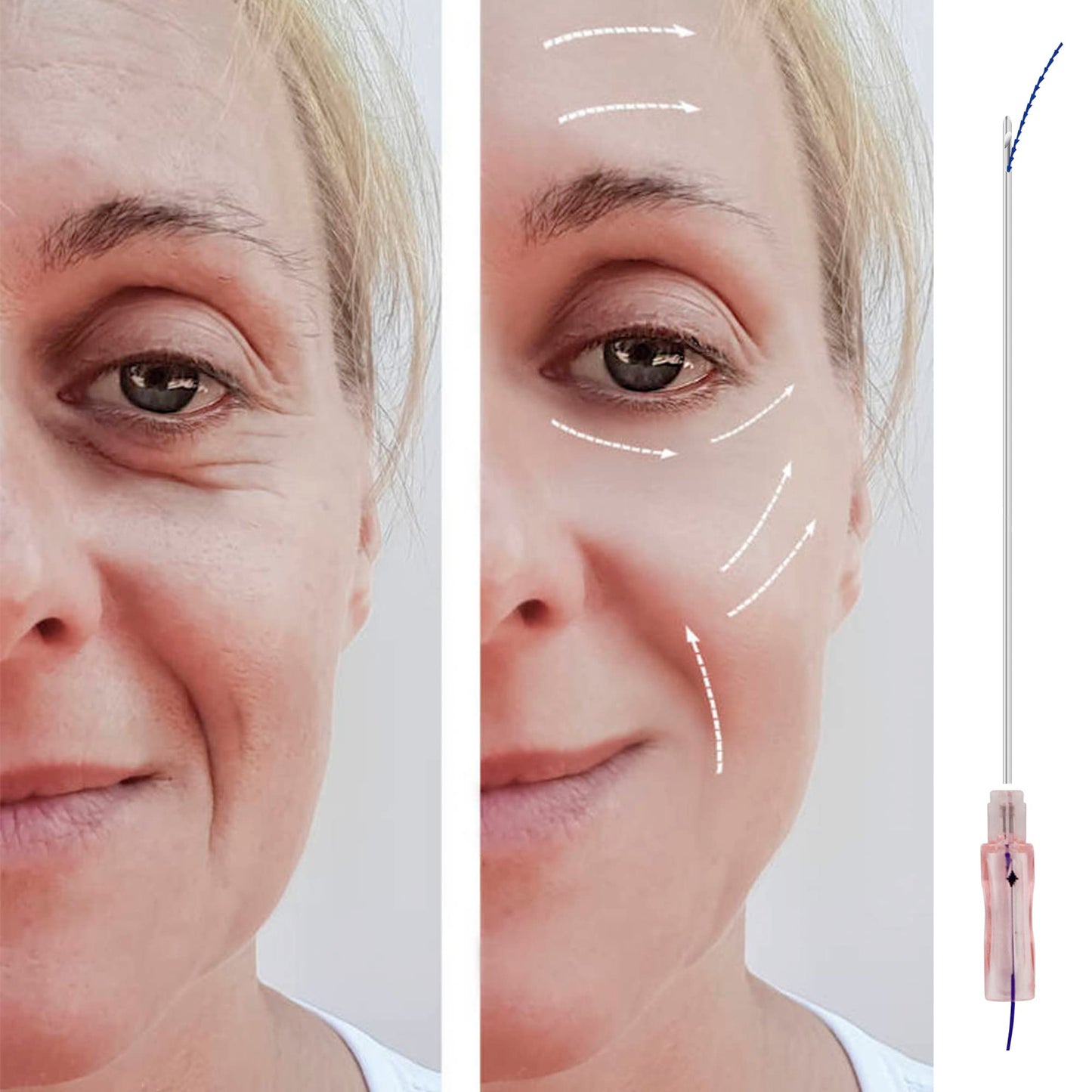 HYPOD Pdo Threads Lifting Fishbone, Pdo Thread Curved Barb 360 Degree Spiral Two Way Barb 16pcs, 18G100mm