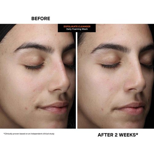 Kate Somerville ExfoliKate Cleanser – Daily Exfoliating Foaming Face Wash, Clinically Formulated Glycolic Acid and Lactic Acid Gentle Facial Scrub, 8 Fl Oz