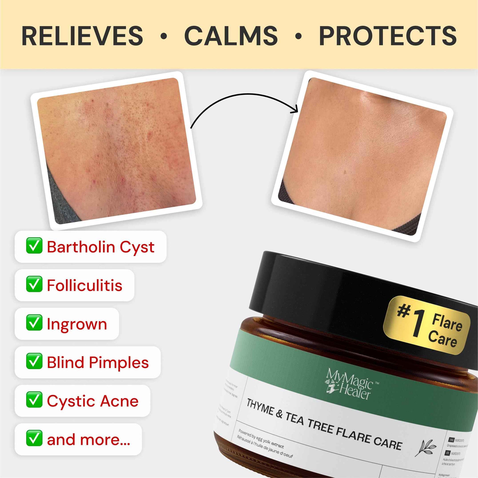 MyMagicHealer Comfort Flare Care | 1oz Collection of All-Natural Salves for Skin Flare-Ups Convenient Relief for Skin Flare-Ups, Acne, Boils, Muscle & Joint Discomfort – Perfect for Travel