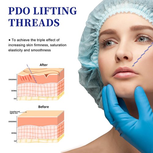 SOZOOM PDO Screw Threads, PDO Thread Lift KOREA Pdo Threads Whole Body Lifting (100PCS-29G-38mm)