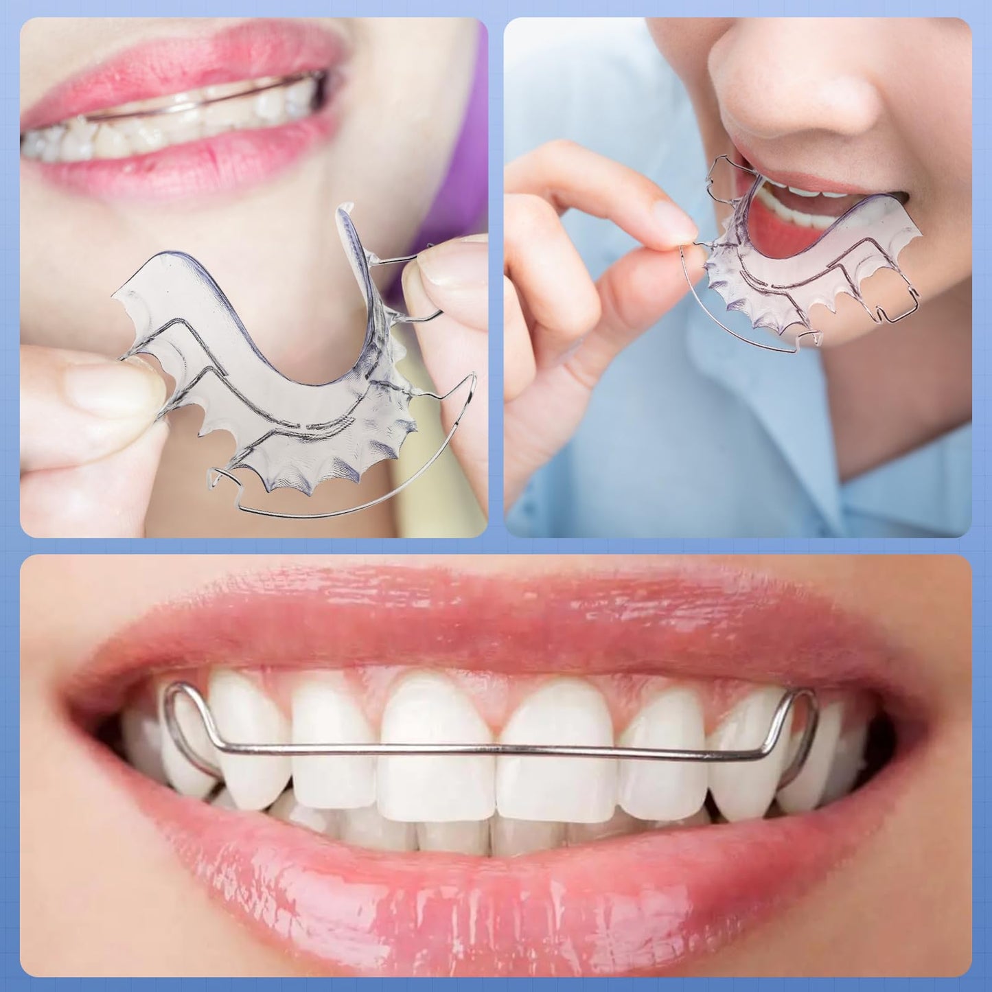 2 Hawley Retainer for Custom Teeth Retention, Custom-Fit Upper and Lower Retainers - Comfortable and Durable