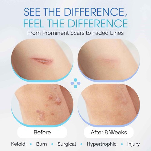 Medical Grade Silicone Scar Sheets - Long Water-Resistant Silicone Scar Tape - Advanced Solution for Surgical Scars, Stretch Marks, and Keloids - 7-Inch Strips, 12-Pack