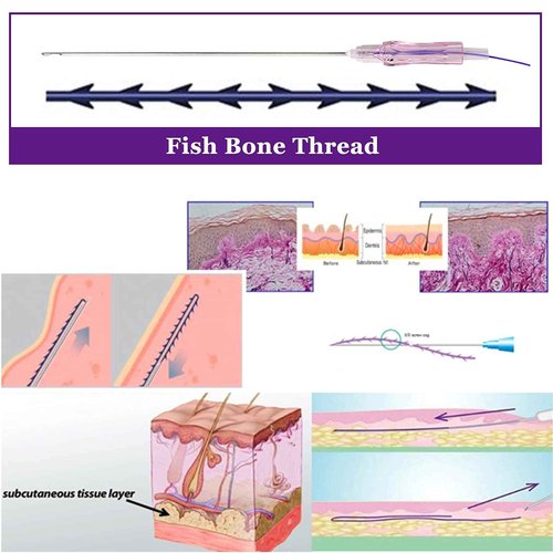 PHYMAT ACADA Pdo Threads for Face Lift Cog 18G100mm Pdo Fishbone Thread Bullet Blunt Cog Threads for Face Lift 20Pcs