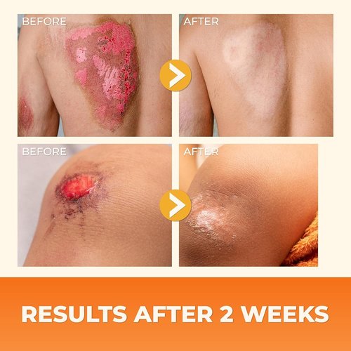 ABERA Scar Cream (Upgrade) - Skin Regeneration & Repair Cream - Heals Wounds, Promotes New Skin Formation, Soothes Scratches, Eczema, and Damaged Areas (Set 2) (1.41 Oz Per Item)