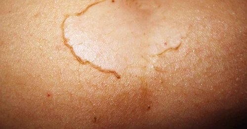 Baiden Exfoliator System-Best Firming Face Body & Back Scrub Mitts-Remove Blackheads, Dry Skin, Wrinkles, Cellulite, Controls Acne-Top Facial Lips Eyelids Treatment-Circulation and Collagen Boosting