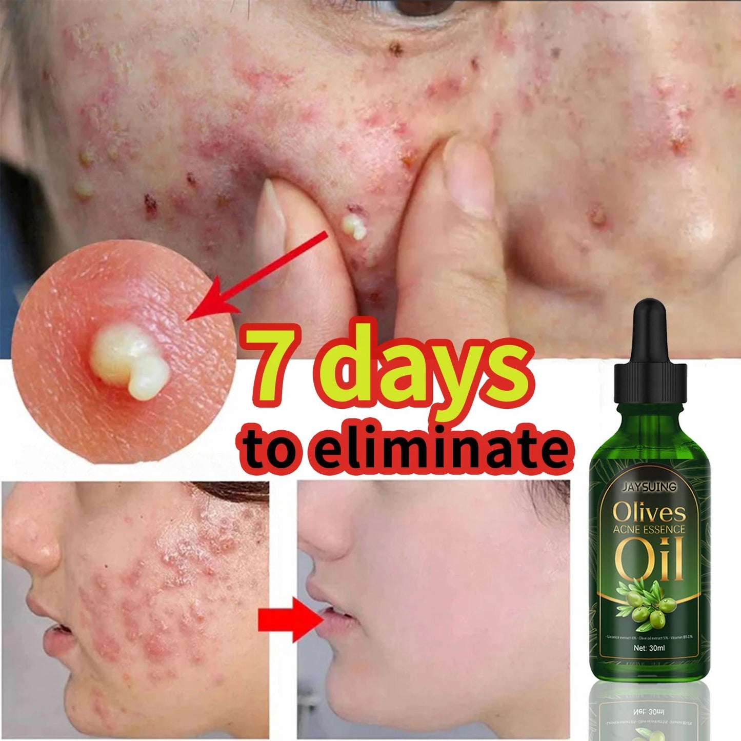 Acne Face Oil - Gentle Moisturizer for Acne Marks & Pit Repair 30ml