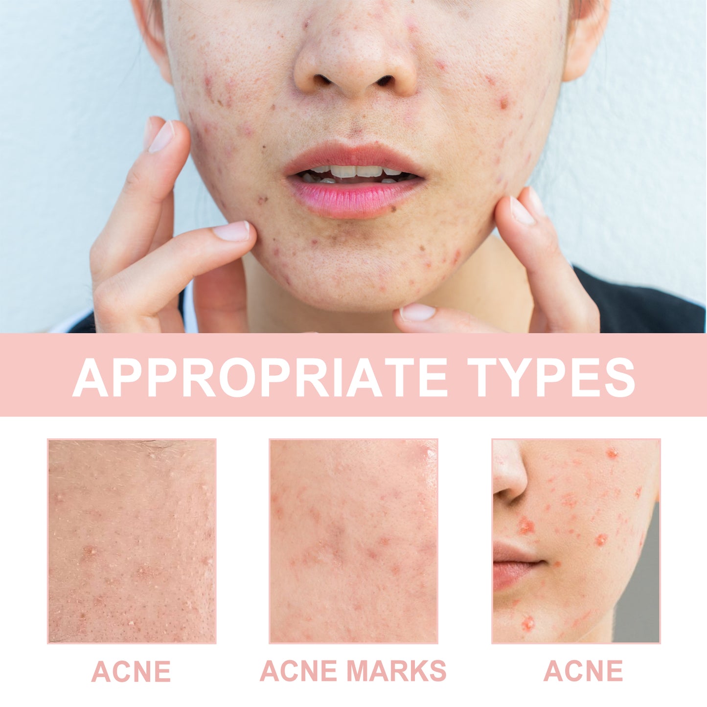 Acne Pimple Patch with Hyaluronic Acid & Vitamin B5 for Pore Cleansing
