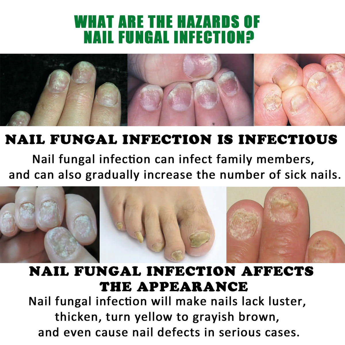 Ginger Nail Care Solution 30ml - Soft Nails