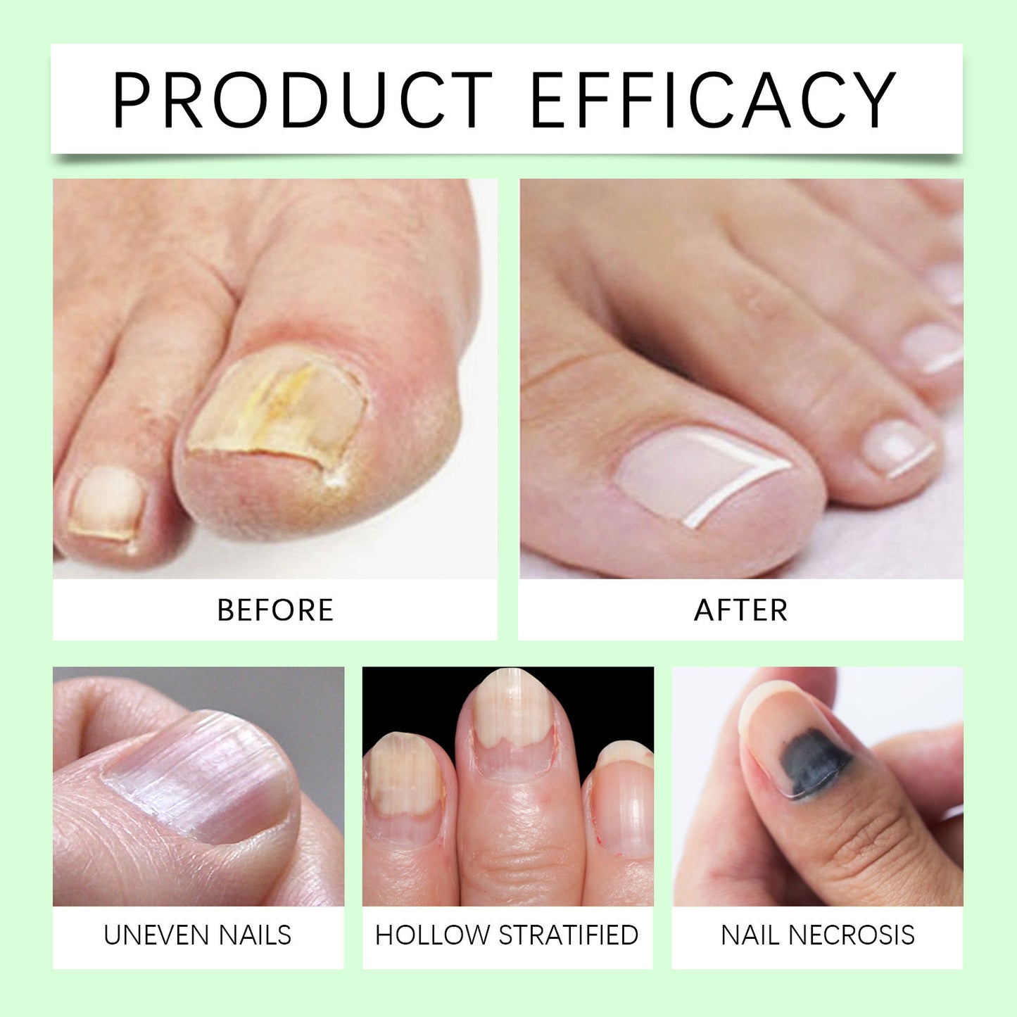 Onychomycosis Hand and Foot Nail Repair Essence - 30ml Skin Care Solution