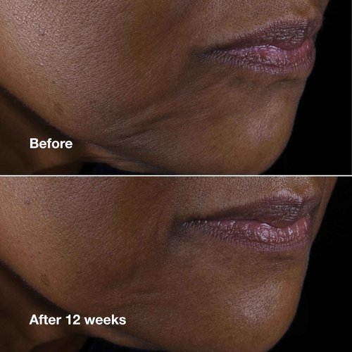 Clinique Smart Clinical Repair Anti Aging Lifting Face + Neck Cream with Peptides + Hyaluronic Acid For All Skin Types| Hydrating, 1.7 Fl Oz