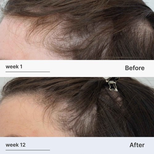 Better Not Younger Superpower™ Thickening Hair Patches for Women 40+ – Hydrogel Hair Regrowth Treatment for Thinning Hairline & Temples. Infused with Capixyl™ & Plant Extracts for Thicker, Fuller Hair