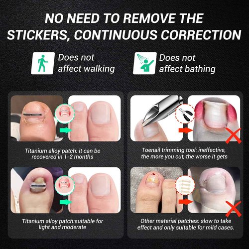 Reieset Titanium Alloy Ingrown Toenail Treatment, Nail Tools, and Ingrown Toenail Removal Kit Specially Designed for Curved Nail Repair and Ingrown Toenail Corrector (0.67/0.79in)