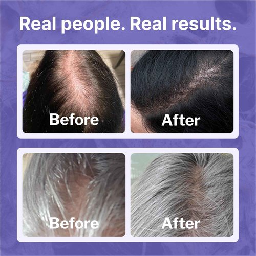 Shapiro MD Hair Growth Experts Minoxidil 2% Topical Solution for Women, Serum Promotes Hair Regrowth by Reactivating Hair Follicles (3 Month)
