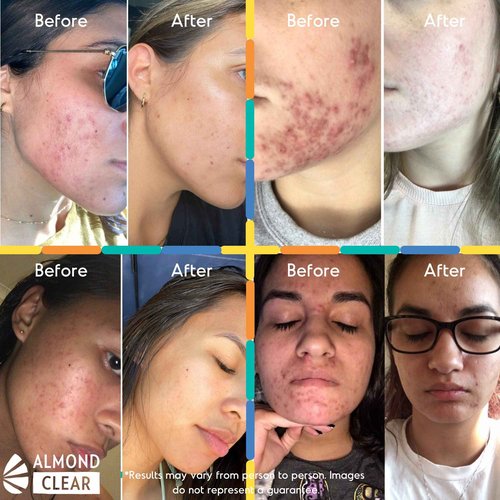 Almond Clear Face & Body Start Kit | Skin Care Kit for Oily Skin, Acne & Folliculitis - Includes Face & Body Wash, Facial Acne Serum, and Body Acne Serum