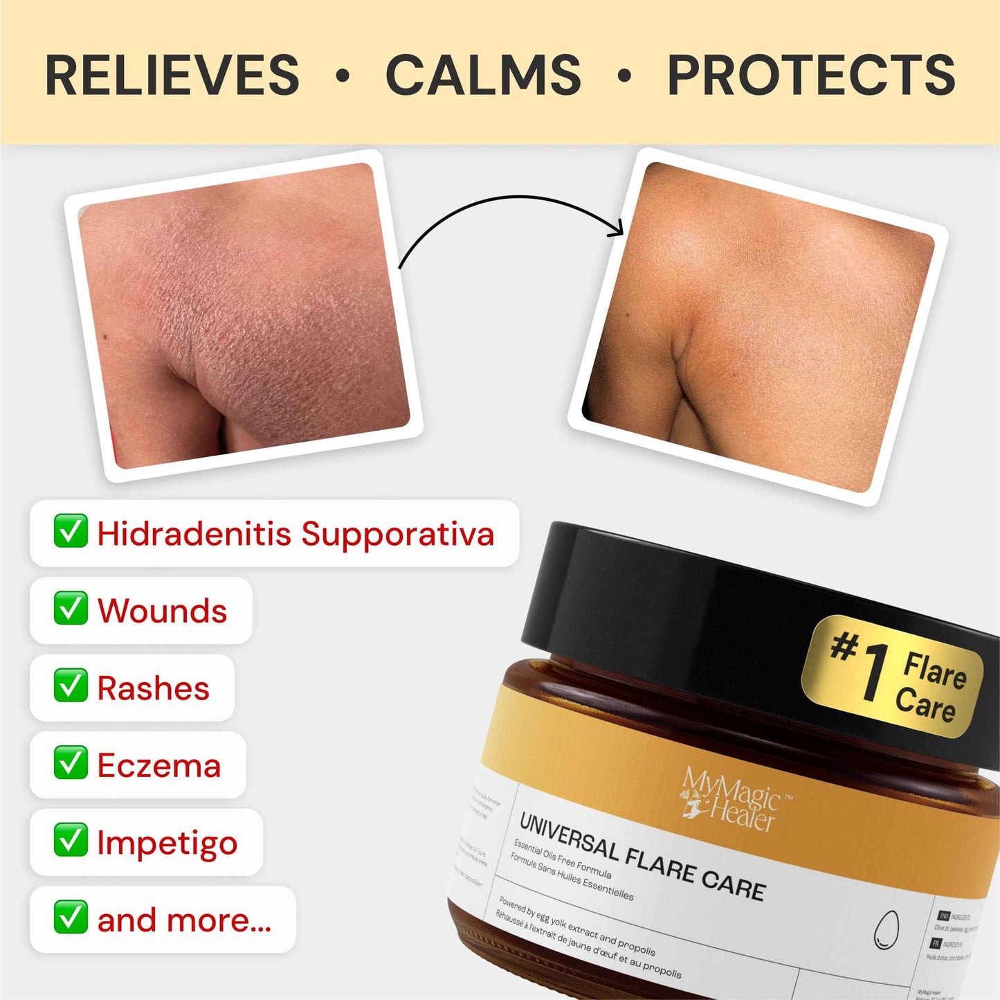 MyMagicHealer Comfort Flare Care | 1oz Collection of All-Natural Salves for Skin Flare-Ups Convenient Relief for Skin Flare-Ups, Acne, Boils, Muscle & Joint Discomfort – Perfect for Travel