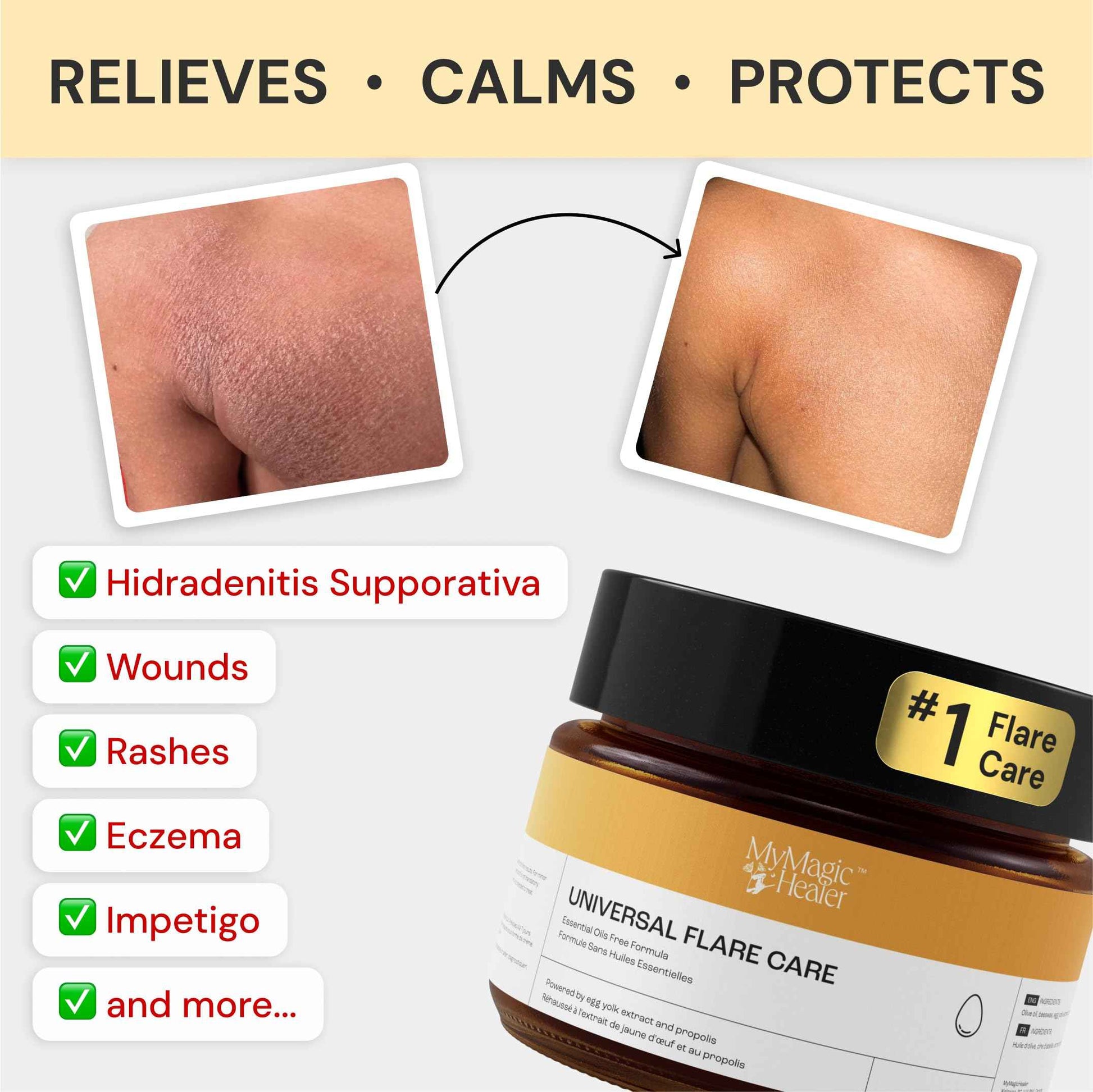 MyMagicHealer Comfort Flare Care | 1oz Collection of All-Natural Salves for Skin Flare-Ups Convenient Relief for Skin Flare-Ups, Acne, Boils, Muscle & Joint Discomfort – Perfect for Travel