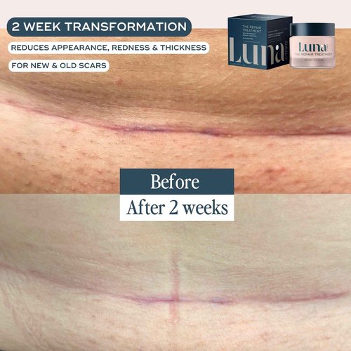 Luna Daily Stretch Mark & Scar Treatment Gel | Daily Repair Moisturizer for Body, Acne & Post-Surgery Scars | With Arnica & Hydrating Actives | Supports Skin Healing, Smoothness & Recovery, 50ml