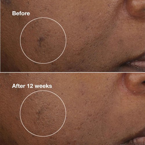 Clinique Even Better Clinical Brightening Moisturizer With Salicylic Acid, Glucosamine + Vitamin C | Hydrating + Dark Spot Reducing, 1.7 Ounce