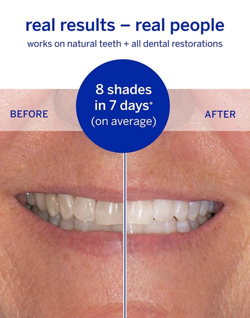 Whitening Strips, Superstrips by Supersmile, Professional Teeth Whitening Strips, Enamel Safe Teeth Whitener for Sensitive Teeth